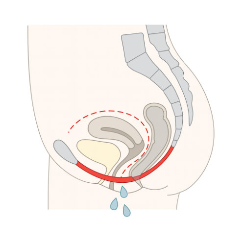 Vor der Beckenbodenbehandlung